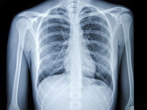 Normal Lung Ct Scan