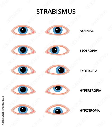 Types of strabismus. Eyes with esotropia, exotropia, hypertropia and ...