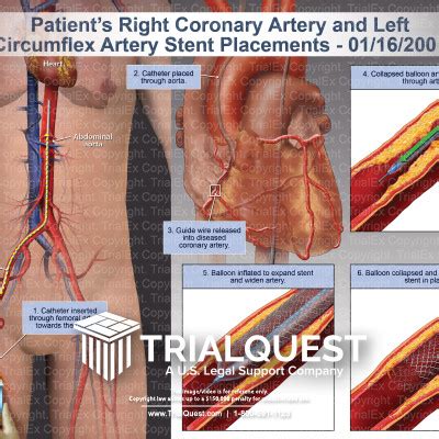 Right Coronary Artery and Left Circumflex Artery Stent Placements - TrialExhibits Inc.