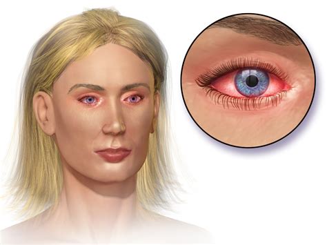 Allergic conjunctivitis - Wikipedia