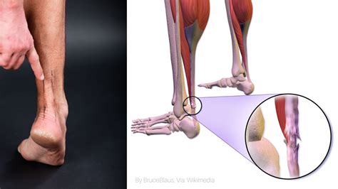 Achilles Rupture Tendon: Everything you should know