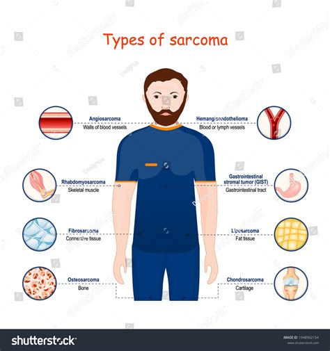 Sarcoma Types Malignant Tumor Cancer That Stock Vector (Royalty Free) 1948902154 | Shutterstock