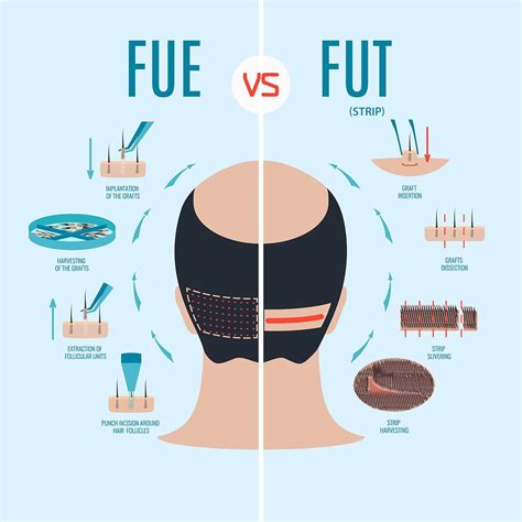 Hair Transplant STRIP or FUE - Dr Piotr Turkowski