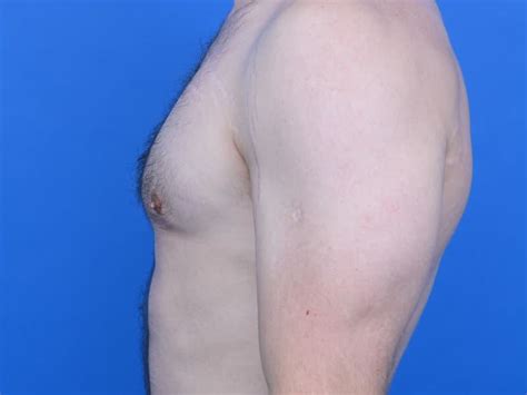 Gynecomastia Surgery Before & After Patient 21984 | AGC