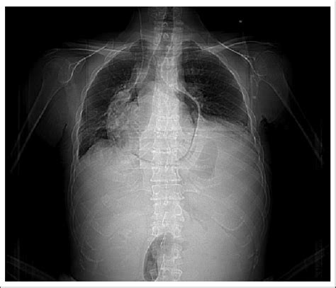 Chest X-ray showing pneumopericardium and left diaphragmatic cupola ...