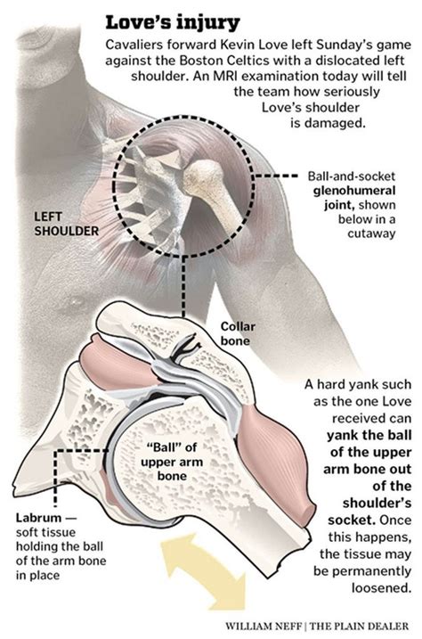 Kevin Love shoulder injury: How it happened, how PD photographers got the shots - cleveland.com