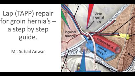 Laparoscopic Hernia Repair Taap For Right Side Complete Inguinal Hernia | SexiezPicz Web Porn