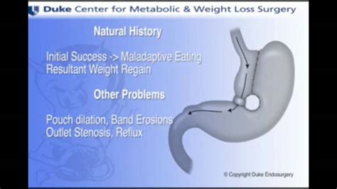 Management techniques for failed vertical banded gastroplasty ...