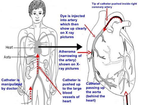 About Coronary Angiography Test Procedure, Dos and Donts