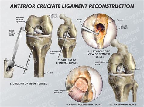 Anterior Cruciate Ligament Acl Reconstruction Surgery Explained – NBKomputer