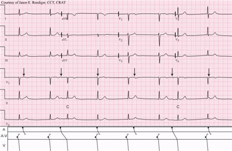 Junctional escape rhythm | ECG Guru - Instructor Resources