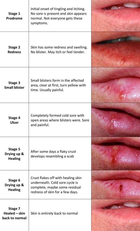 Managing Recurrent Herpes Labialis – Morning Huddle