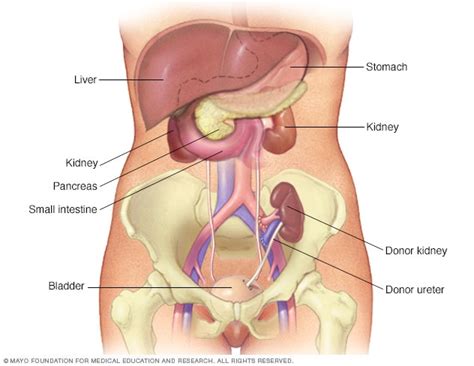 Kidney transplant - Mayo Clinic