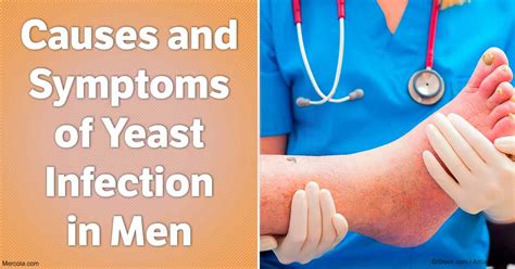 Yeast Infection Symptoms