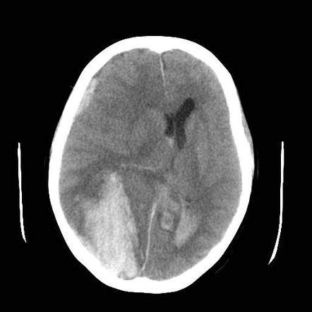 Intracerebral hemorrhage | Radiology Reference Article | Radiopaedia.org