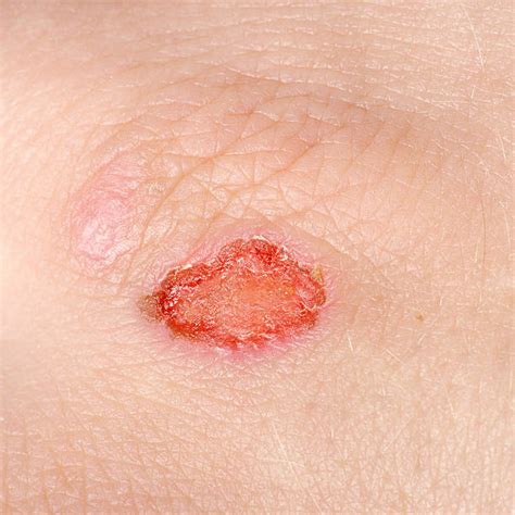 Best Infected Wound Stock Photos, Pictures & Royalty-Free Images - iStock