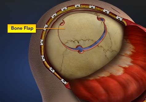 Craniotomy and Craniectomy: Severe Brain Injury Primer Four