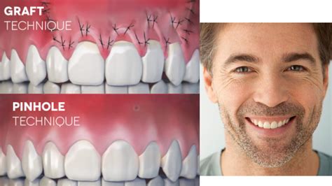 Pinhole Gum Surgery - Is it Right For You? - PRV Dental