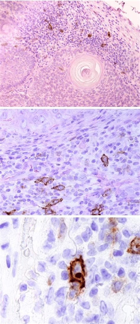 mmunostaining for CD30 showing how many CD30+ cells were easily found ...