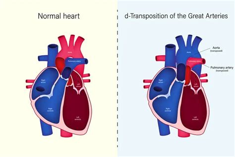 Transposition of the Great Arteries: Understanding Causes, Symptoms ...