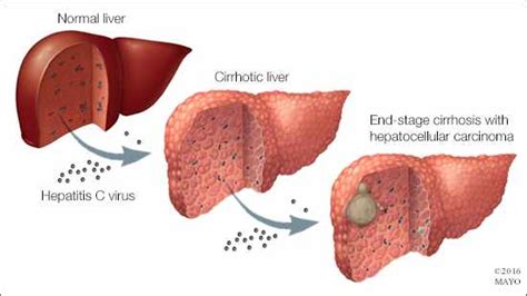 Living With Cancer: Hepatocellular carcinoma - Mayo Clinic News Network