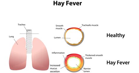 Hay Fever: Symptoms, Causes, Prevention and Treatments