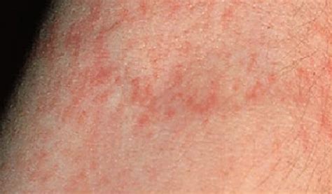 scarlet fever rash image - pictures, photos