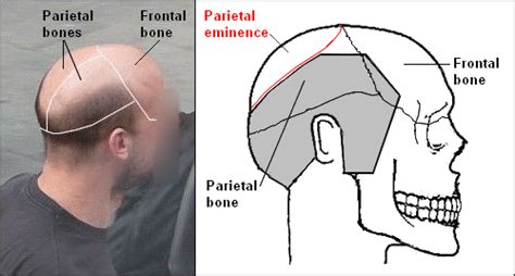 Why Bald Spots Develop at the Back of the Head