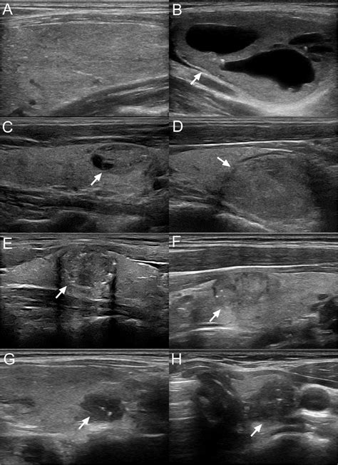 a C-TIRADS 1: diffusely enlarged thyroid with heterogeneous ...