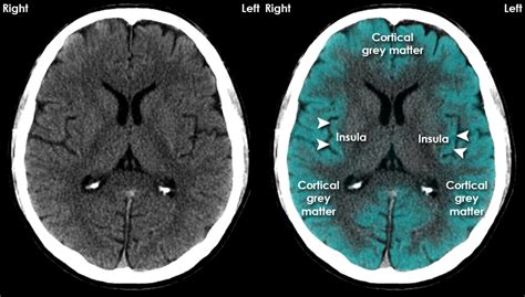 Basal Ganglia Anatomy Axial