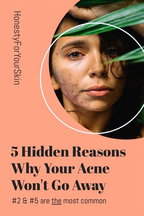 Acne Clinic, Skin Clinic, Acne Spots, Spots On Face, All Natural Skin Care, Natural Beauty ...