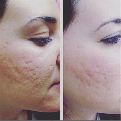 Acne Scars Before And After Chemical Peel