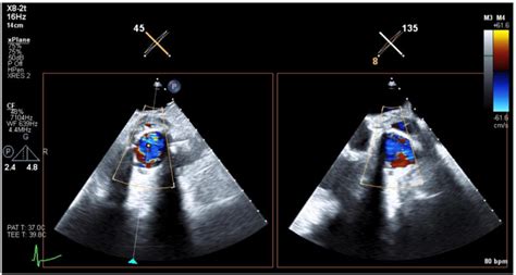 -Transthoracic echocardiogram (TTE) images centered at the aortic valve ...