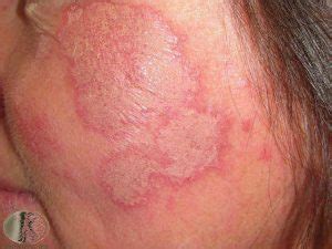 Cutaneous Lupus Treatment- Colorado Springs & Monument, CO