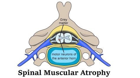 Spinal Muscular Atrophy: Definition, 3 Types, Symptoms, And Treatment ...