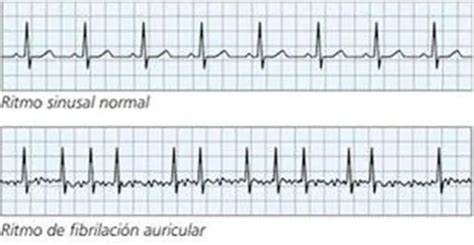 1-fibrilacion-auricular-electrocardiograma - Ocronos - Editorial ...