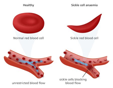 Gene therapy may cure sickle-cell anemia.