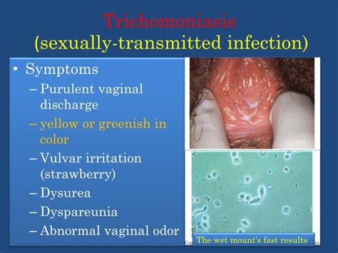 Infections Vaginitis Trichomoniasis Bv Candidiasis Flashcards | My XXX ...