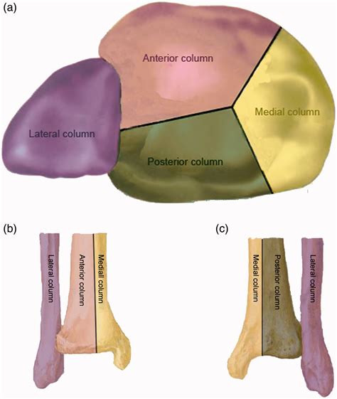 Schematic layout of four-column classification of tibial plafond. (a ...