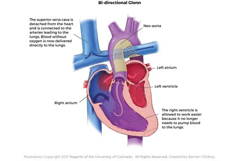 Glenn Shunt Procedure