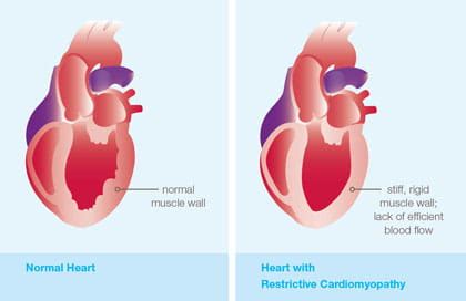 Restrictive Cardiomyopathy (RCM) | Pediatric Cardiomyopathy