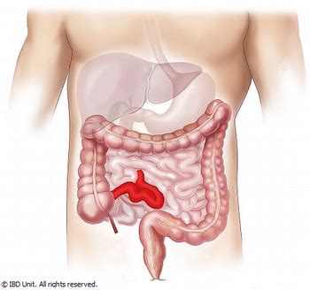 Crohn's disease | IBD Clinic