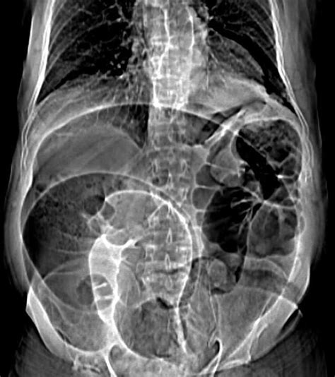 Volvulus definition, causes, volvulus types, diagnosis & volvulus treatment