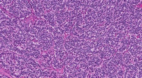 Typical carcinoid tumour of the lung - MyPathologyReport.ca