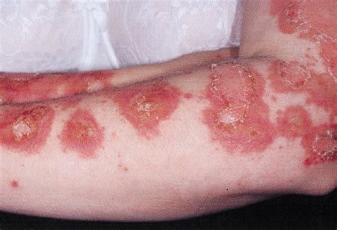 Frequency and Severity of Systemic Disease in Patients With Subacute Cutaneous Lupus ...