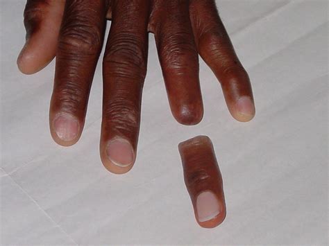 Dermatos® Fingers - Alatheia Prosthetic Rehab