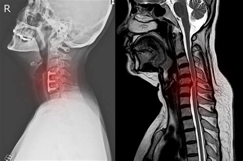 Chirurgie du rachis : Rachis cervical - Chirurgie du dos