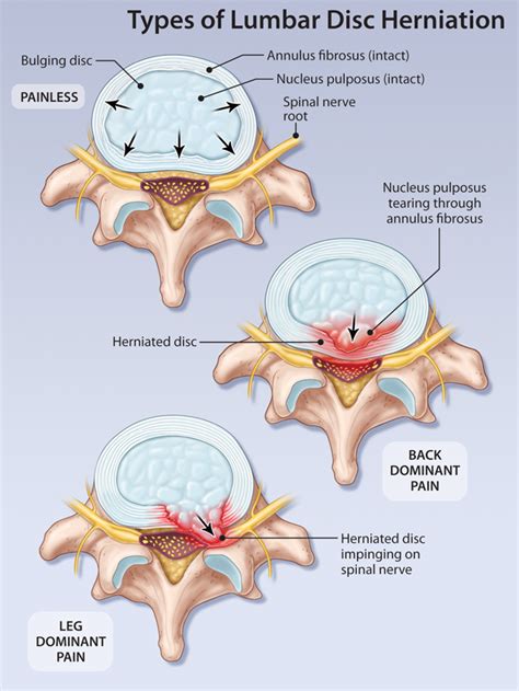 Current Management of Symptomatic Lumbar Disc Herniation | HealthPlexus.net