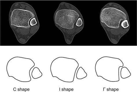 Illustrations of the DTS classification system in 3 different types... | Download Scientific Diagram