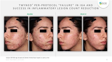 FDA Approves Twyneo (tretinoin and benzoyl peroxide) for the Treatment of Acne Vulgaris-CliniExpert